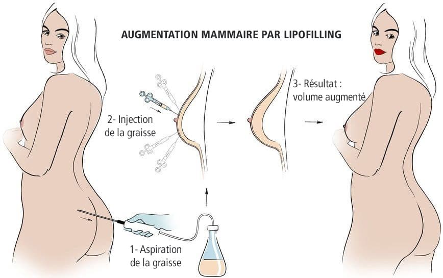 lipofiling mammaire par injection de graisse