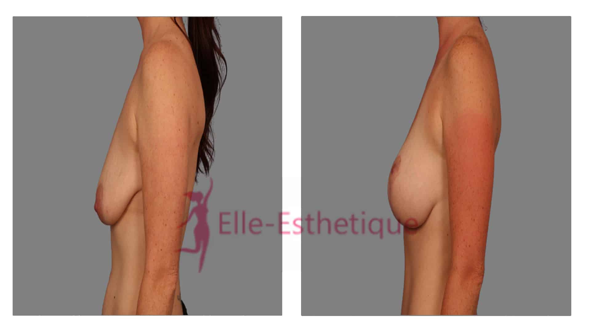 Lifting mammaire vue profil