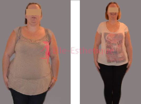 Abdominoplastie en Tunisie: Le guide complet pour un ventre plat en 5 ...