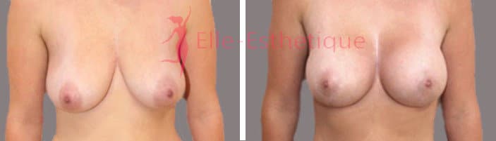 lifting-mammaire lifting-mammaire