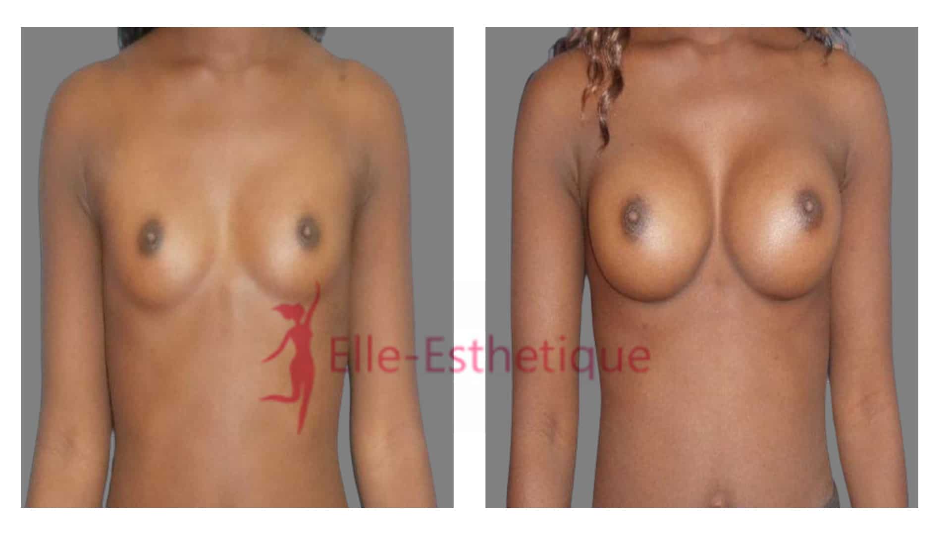 augmentation mammaire prothese ronde