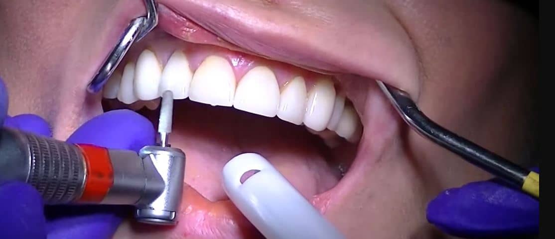 veneers dentaire