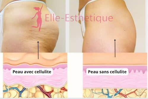 illustration peau avec cellulite vs sans cellulite
