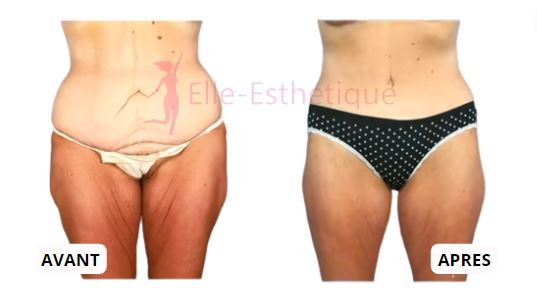 Body lift avant apres perte de poids massive patiente de 41 ans vue de face