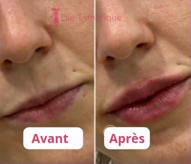 avant apres injection au levres par nano-lipofilling 3