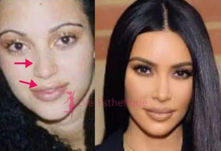 Kim Kardashian avant apres nez et levres refaites
