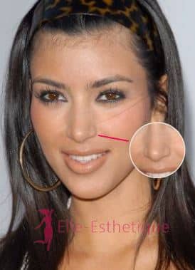 Kim Kardashian avant les interventions au visage